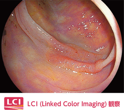 LCI（Linked Color Imaging）