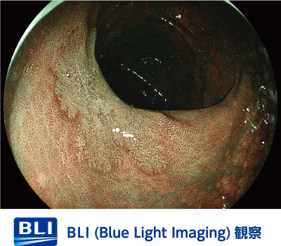BLI（Blue Light Imaging）